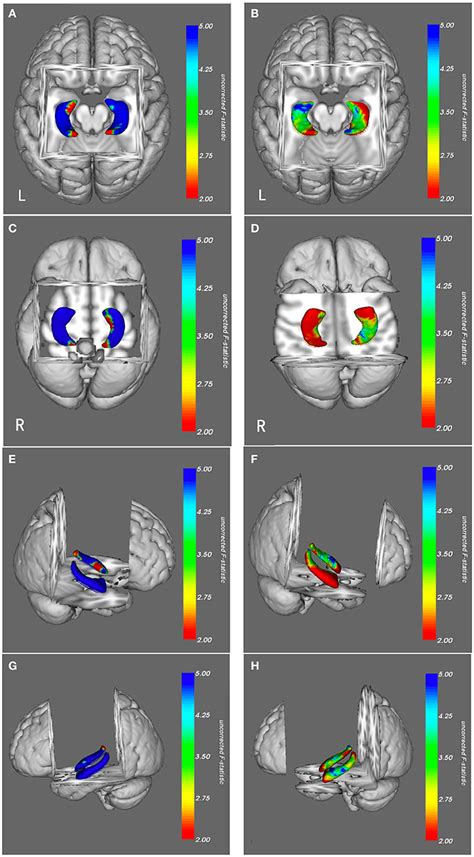 Frontiers | Identifying Morphological Patterns of Hippocampal Atrophy in Patients With Mesial ...