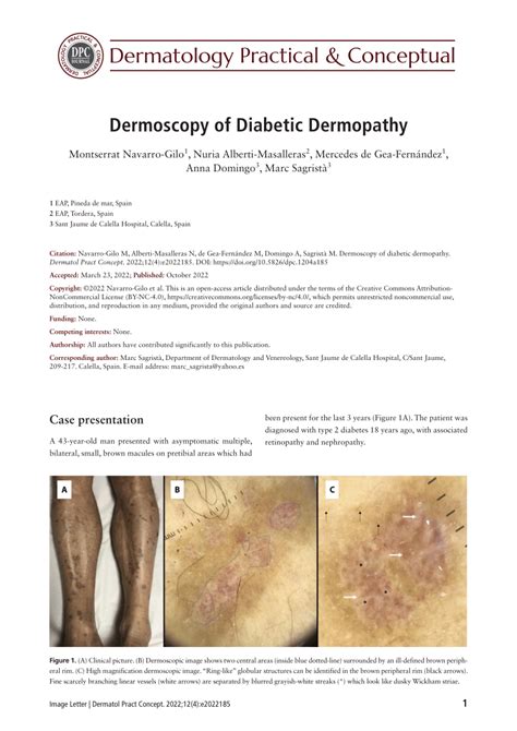 (PDF) Dermoscopy of Diabetic Dermopathy