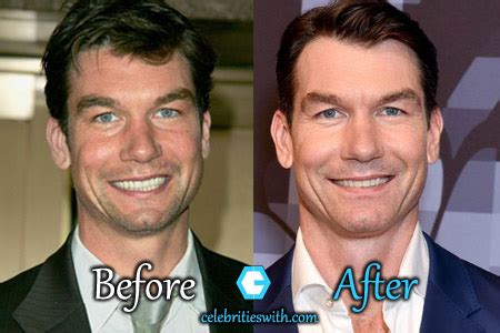 Jerry O'Connell Plastic Surgery, Before After Facelift, Botox Pictures ...