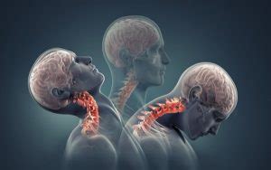 How to Prevent Cervical Lordosis? Causes, Symptoms, Treatment and Exercises