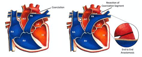 Coarctation of the Aorta - Pediatric Cardiology Associates of Houston