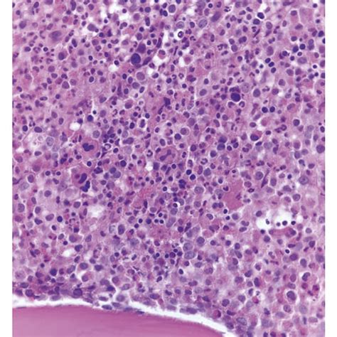 (a) Peripheral blood smear demonstrating a leukocytosis with myeloid... | Download Scientific ...