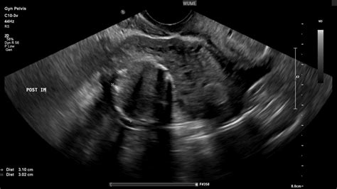 Fibroid2 - Women's Ultrasound Melbourne