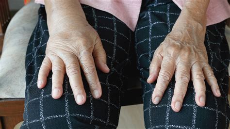 The Four Lymphedema Stages: From Symptoms to Treatment