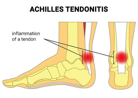 Achilles Tendon Rupture Surgery NJ | Achilles Tendon Tear Repair