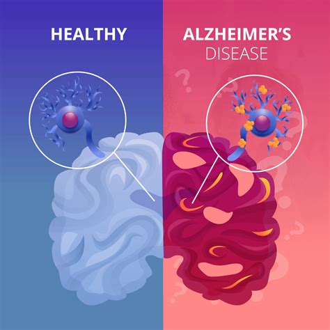 Alzheimer's Disease: The Basics - Alzheimer's Los Angeles