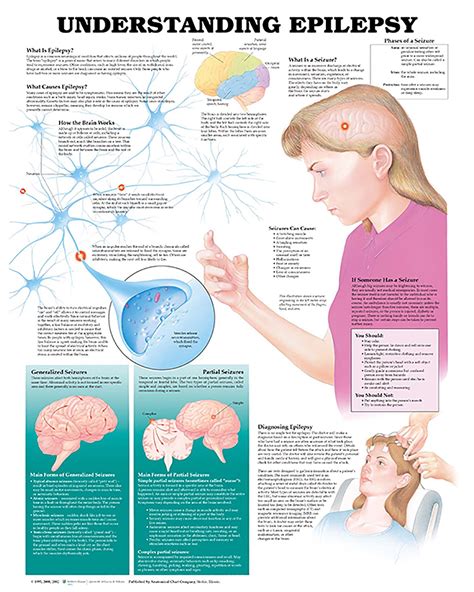 Understanding Epilepsy Anatomical Chart - Soft Laminate - Australian Physiotherapy Equipment