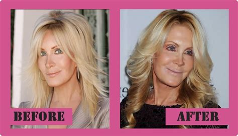 Joan Van Ark Plastic Surgery - Was A Failure