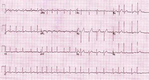 Irregular Rhythms — Maimonides Emergency Medicine Residency