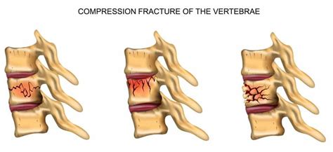 Spinal Fractures: Types, Causes, Symptoms, Diagnosis, and Treatments - Spine Info