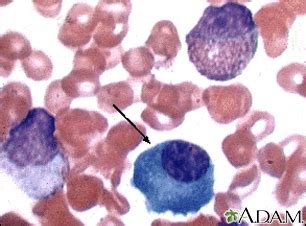 HIE Multimedia - Waldenström macroglobulinemia