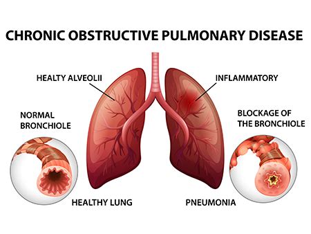 Lung disease - Types, Symptoms, Causes and Prevention