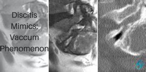 Discitis Mimics : Vacuum Phenomenon ( Gas in the disc) - Radedasia