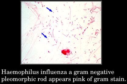 Haemophilus Influenza Gram Stain