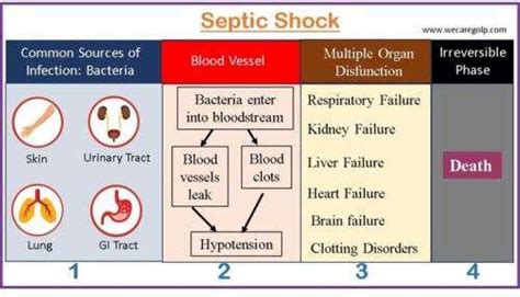 Septic Shock: Risk Factors, Symptoms, Management - We Care