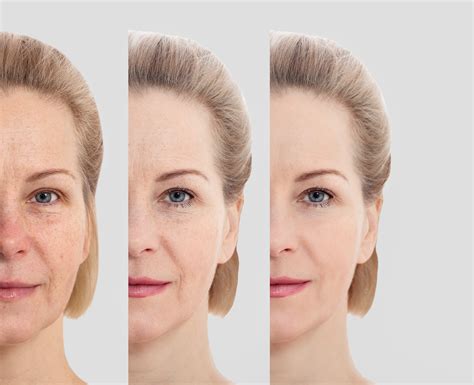 Ozempic Face: How Rapid Weight Loss Affects Facial Skin | Blog ...