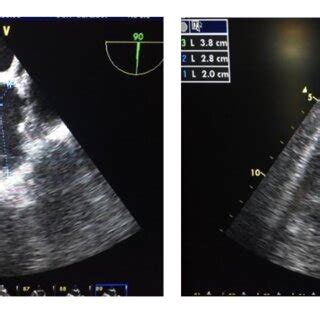 Clinical indications for left atrial appendage closure. | Download ...