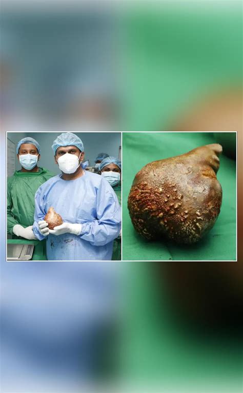 Pic shows world's largest kidney stone removed from Sri Lankan man