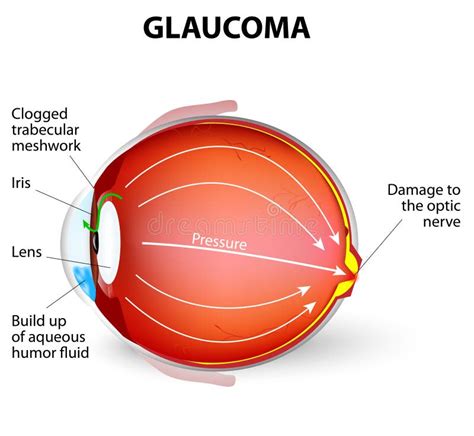 Glaucoma stock vector. Illustration of condition, cell - 40416464