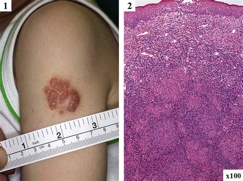 BCG-induced granulomatous inflammation in patients with APDS. 1 ...