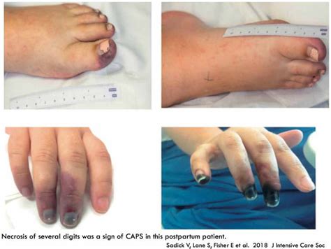 Catastrophic Antiphospholipid Syndrome (CAPS) - EMCrit Project