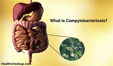 Campylobacteriosis - Symptoms, Diagnosis, Treatment, Prevention