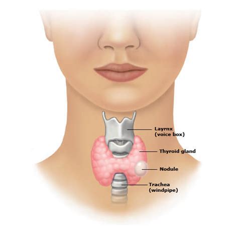 Thyroid Nodules - Symptoms ,Pictures ,Causes And Treatment