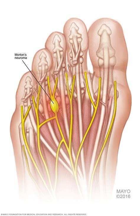 Morton's neuroma Disease Reference Guide - Drugs.com