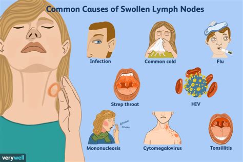 Swollen lymph nodes under arm - sekatopia