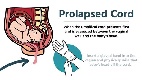 Prolapsed Cord Emt