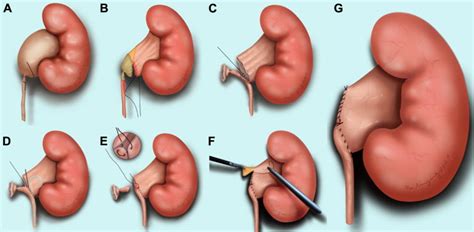 A Modified Suture Technique for Transperitoneal Laparoscopic Dismembered Pyeloplasty of ...