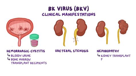 BK virus (Hemorrhagic cystitis): Video & Anatomy | Osmosis