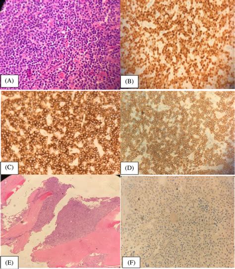 (A) Lymph node histopathology, (B) lymph node immunohistochemistry for ...