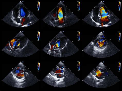 Causes of Congestive Heart Failure | Congestive heart failure, Heart ...