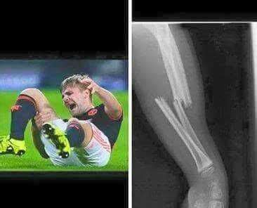 Psv Luke Shaw Injury : Luke Shaw Could Miss Start Of Next Season Because Of Foot Ligament Injury ...