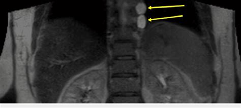 Full-body MRI showing nerve sheath tumors on the left from levels T4 to... | Download Scientific ...