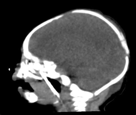 Teratoma - Dental, Orthodontic, Maxillofacial CTs - embodi3D.com