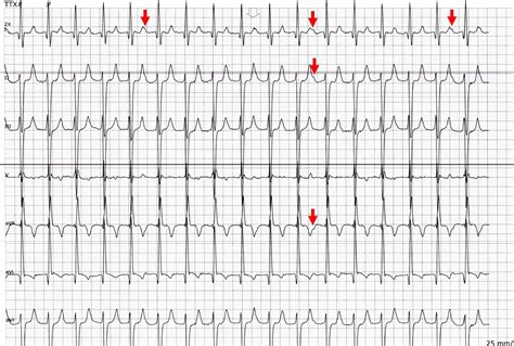 ECG Rhythms: Atrial Tachycardia is Easier to Catch in Telemetry Floors