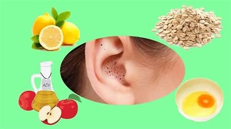 Best Ways To Get Rid Of Blackheads In Ears