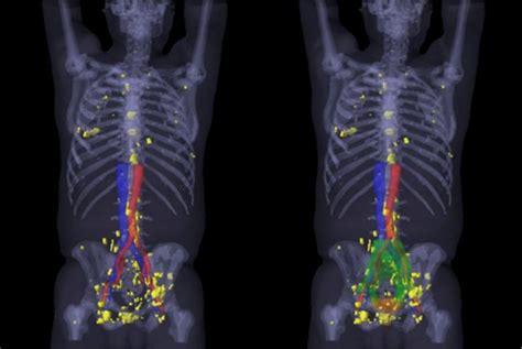 PSMA PET/BT Nedir? Prostat kanseri tanısında en son teknoloji?