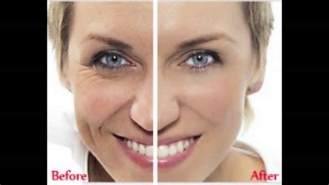 Vitamin C Serum Before And After - YouTube