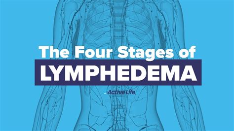 Stages of Lymphedema - YouTube