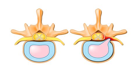 neurosurgeonsofnewjersey-cervical-foraminal-stenosis-causes-symptoms ...