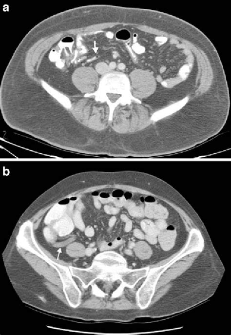 CT appearance of the normal appendix in adults | Semantic Scholar