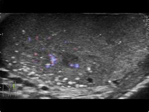 Urinary Tract and male reproductive system | 2.3 Scrotum : Case 2.3.13 Microlithiasis and ...