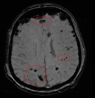 Cavernoma: Treatment & Care | UVA Health