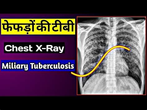 Tuberculosis Lung X Ray