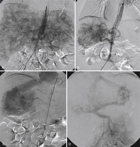 Vascular Anomalies | Radiology Key