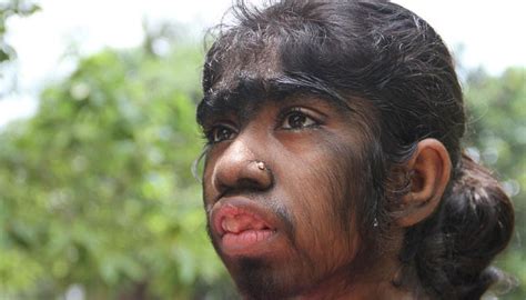 Multiple babies in Spain develop 'werewolf syndrome' after taking ...