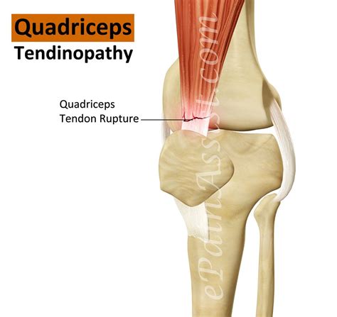 Quadriceps Tendinopathy | Quadriceps tendonitis, Sports injury, Tendonitis treatment